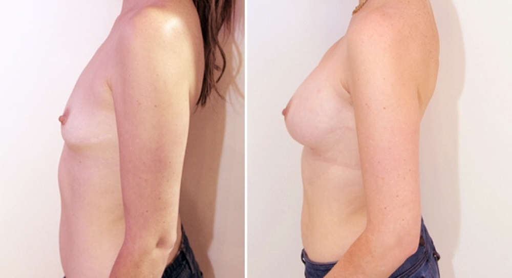 Mid 30's, 2 children, breast augmentation performed using 425g anatomical (teardrop) implants with dual plane 2 placement.