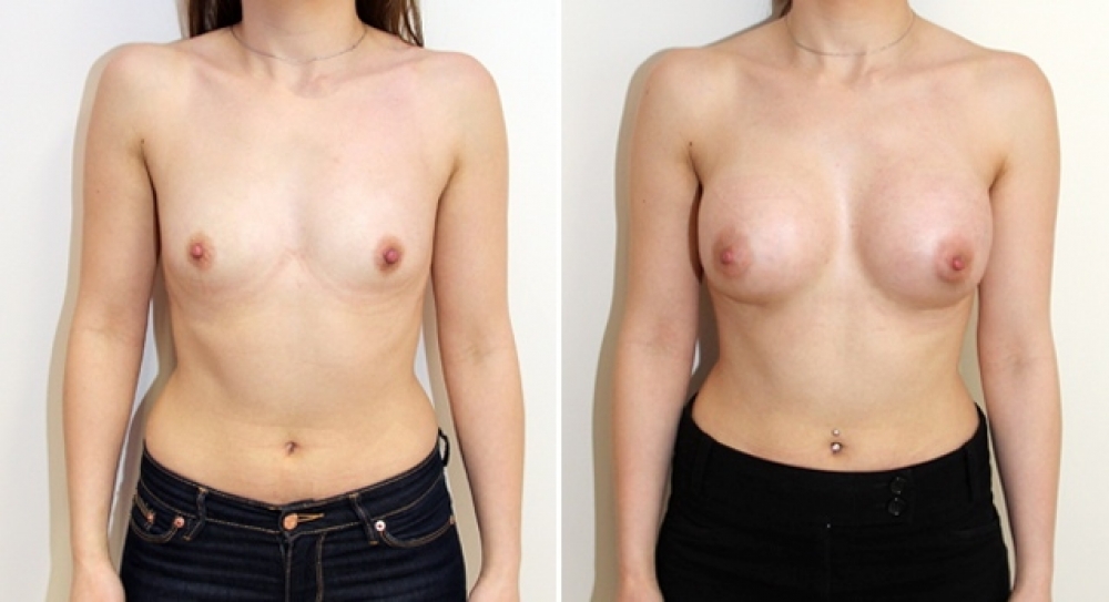 27yo, no children, breast augmentation performed using 295g round implants with dual plane 2 placement.