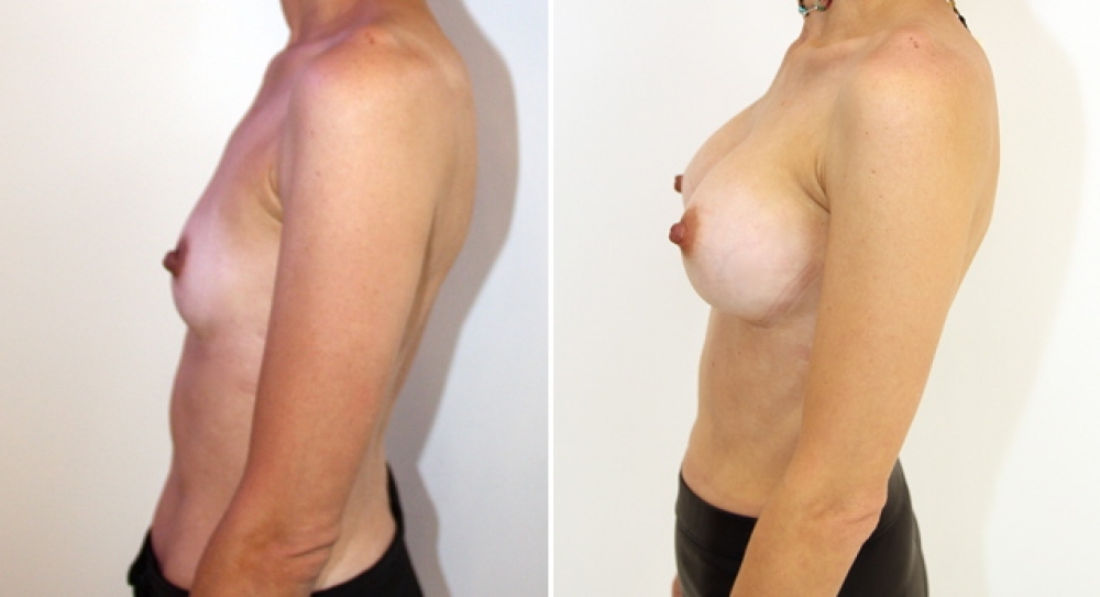 40 yo, 3 children, breast augmentation performed, using 270g anatomical (teardrop) implants with dual plane 2 placement.