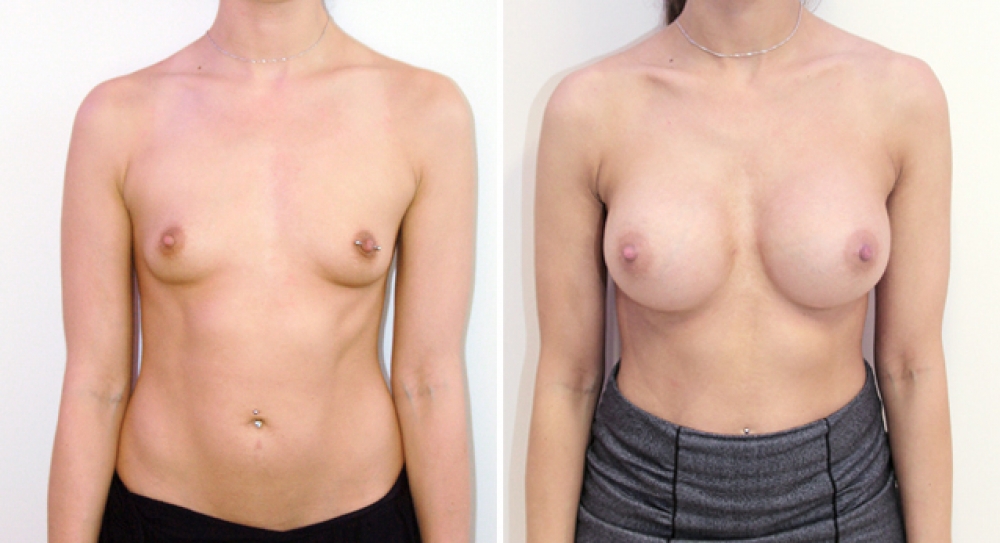 Mid 20s, no children, breast augmentation performed using 460g round implants with dual plane 2 placement.