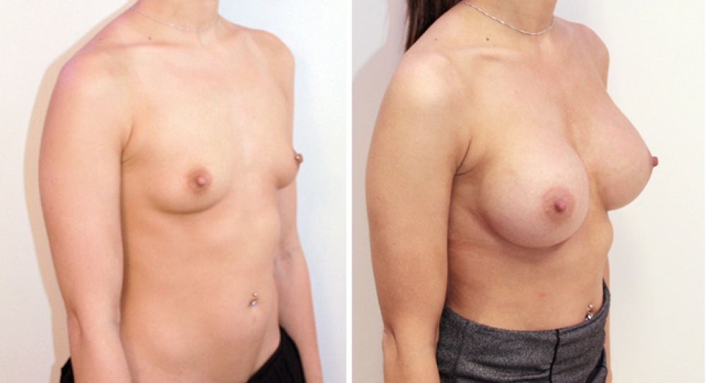 Mid 20s, no children, breast augmentation performed using 460g round implants with dual plane 2 placement.
