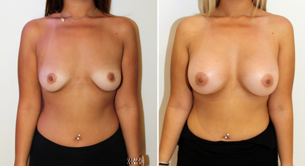20 yo, no children, bilateral breast augmentation performed using 390g anatomical (teardrop) implants, with subfascial placement.