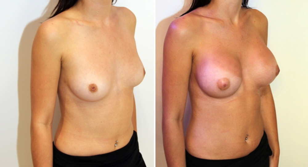 Early 20's, no children, bilateral breast augmentation performed using 350g, round implants, with dual plane 2 placement.