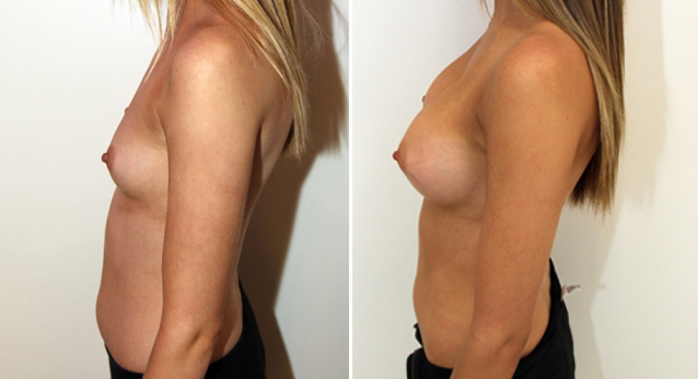 Early 20's, no children, bilateral breast augmentation performed using 345g, round implants, with dual plane 3 placement.