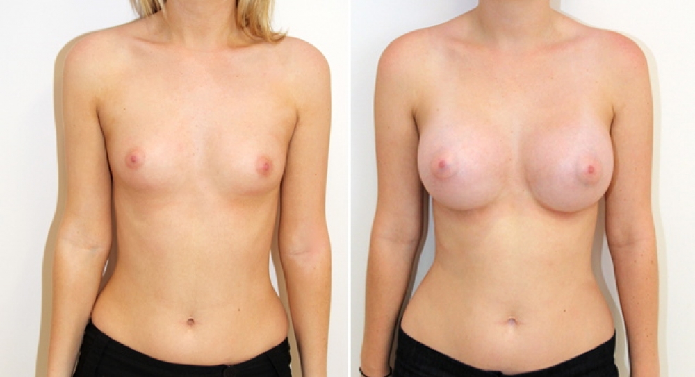 Early 20's, no children, bilateral breast augmentation performed using 390g, round implants, with dual plane 3 placement.