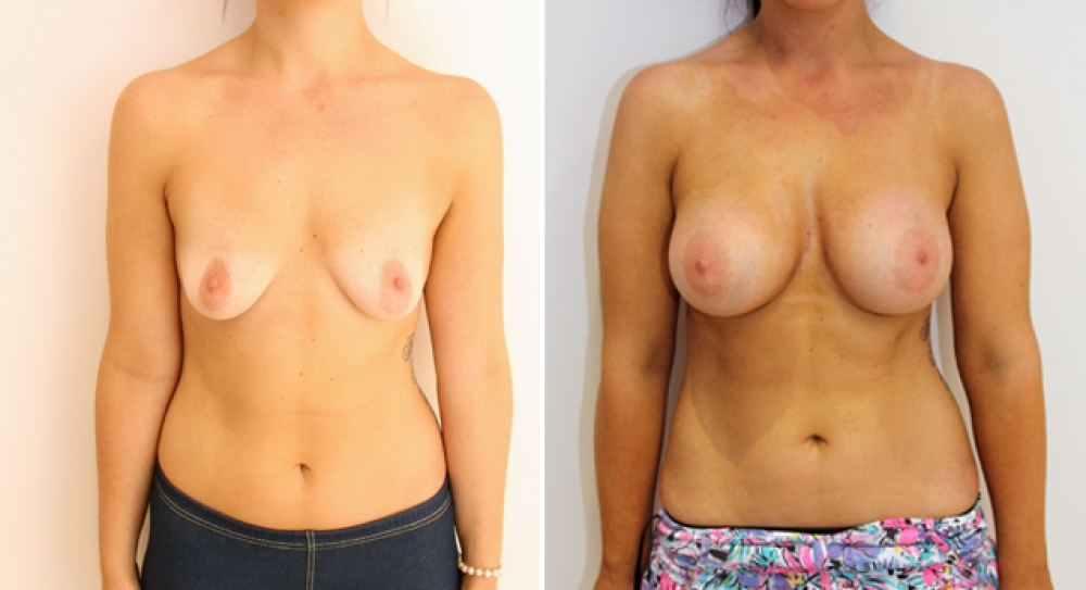 25yo, no children, breast augmentation performed using 390g anatomical (teardrop) implants with subfascial placement.