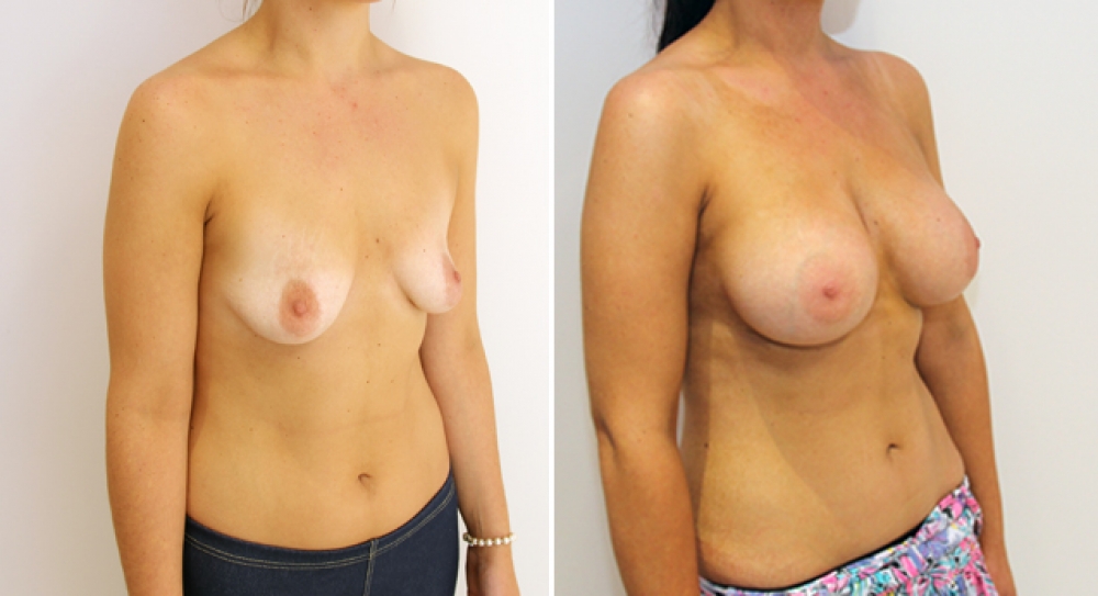 25yo, no children, breast augmentation performed using 390g anatomical (teardrop) implants with subfascial placement.