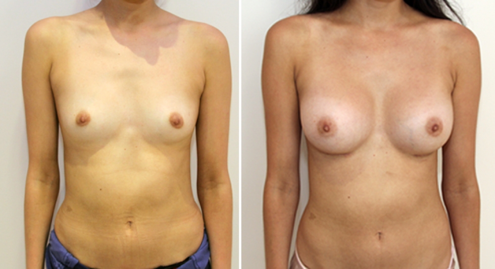 22yo, no children, breast augmentation performed using 315g anatomical (teardrop) implants with dual plane 2 placement.