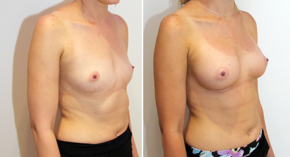 26yo, no children, breast augmentation performed using 315g, anatomical (teardrop) implants with dual plane 2 placement.