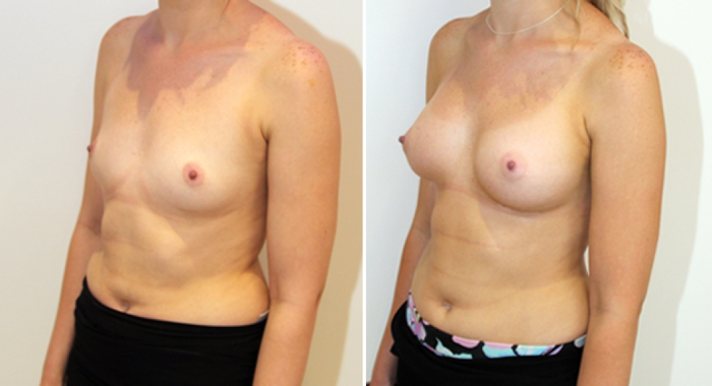 26yo, no children, breast augmentation performed using 315g, anatomical (teardrop) implants with dual plane 2 placement.