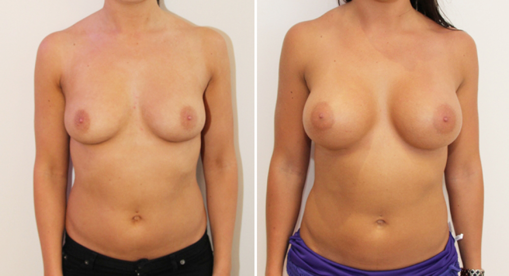 24yo, no children, breast augmentation performed using 425g anatomical P-URE (polyurethane coated) implants with dual plane 1 placement.