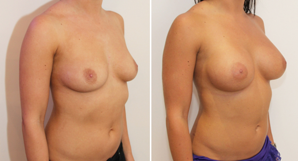 24yo, no children, breast augmentation performed using 425g anatomical P-URE (polyurethane coated) implants with dual plane 1 placement.