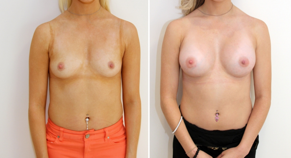 21 yo, no children, breast augmentation performed using 360g hi profile anatomical (teardrop) implants, with dual plane 2 placement.