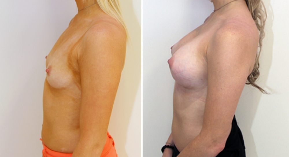21 yo, no children, breast augmentation performed using 360g hi profile anatomical (teardrop) implants, with dual plane 2 placement.