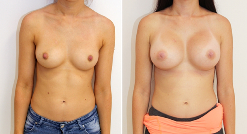 30yo, 2 children, breast augmentation performed using 470g anatomical implants (teardrop) with dual plane 2 placement.