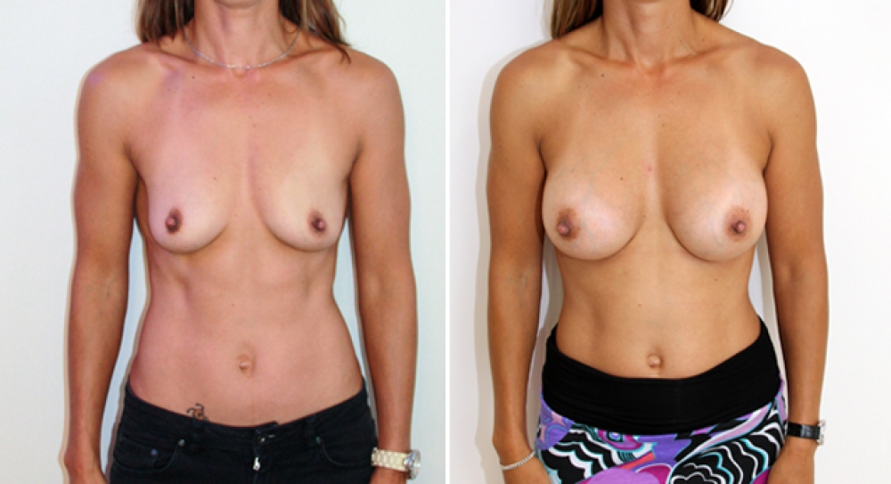 Late 30's, 2 children, breast augmentation performed using 345g anatomical (teardrop) implants with subfascial placement.