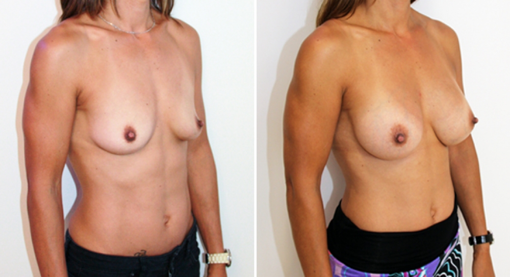 Late 30's, 2 children, breast augmentation performed using 345g anatomical (teardrop) implants with subfascial placement.