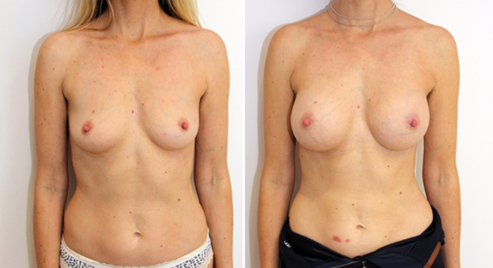 Early 40's, 2 children, breast augmentation performed using 275g round implants with dual plane 2 placement.