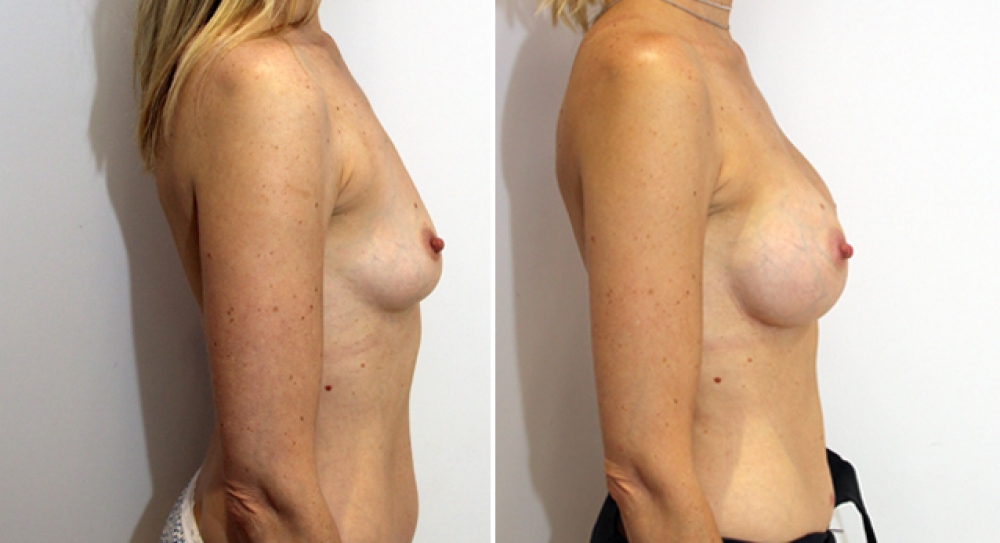 Early 40's, 2 children, breast augmentation performed using 275g round implants with dual plane 2 placement.