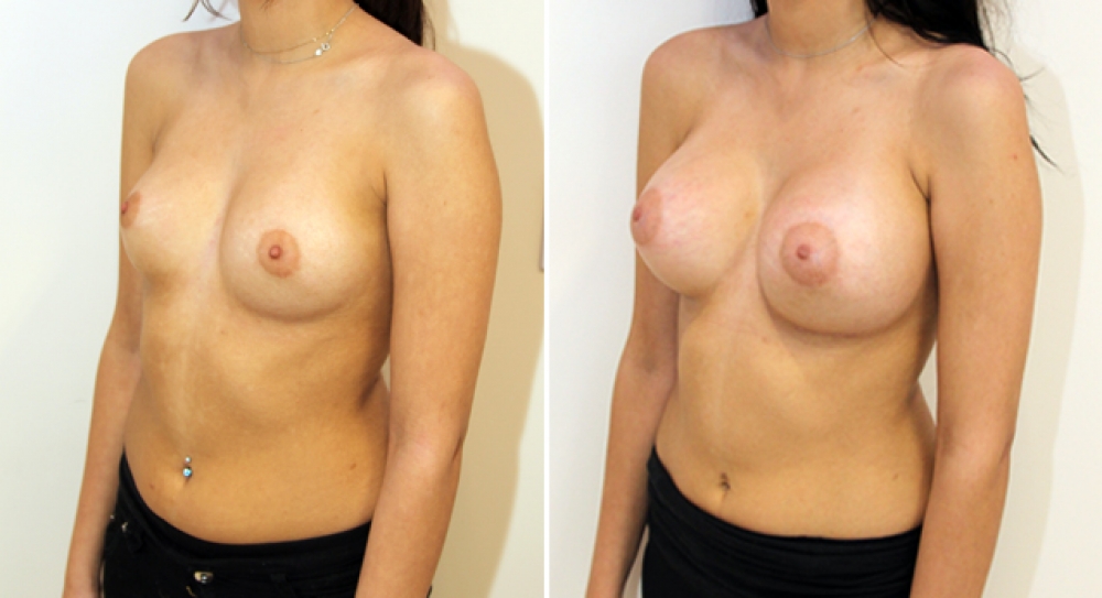 19yo, no children, breast augmentation performed using 345g round implants with dual plane 2 placement.