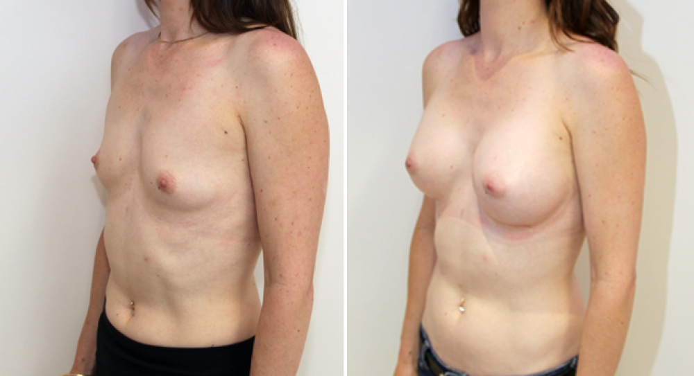 Mid 30s, no children, breast augmentation performed using 350g anatomical (teardrop) implants with dual plane 2 placement.