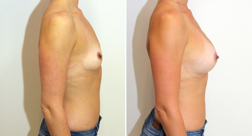 30s, children, 315g moderate profile, anatomic P-URE implants, submuscular placement, A -> full C cup.