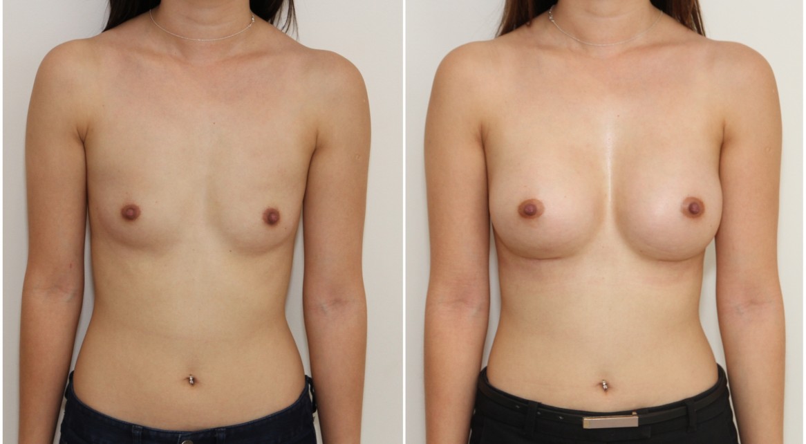 20s, 245cc, anatomical, dual plane 2 placement.