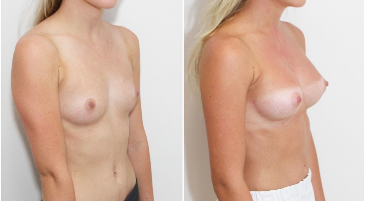 Early 20s, 255g moderate plus profile anatomical (teardrop) memory gel style, dual-plane 2.