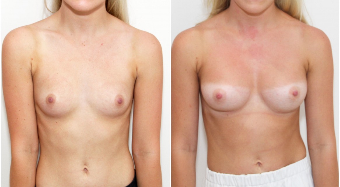 Early 20s, 255g moderate plus profile anatomical (teardrop) memory gel style, dual-plane 2.