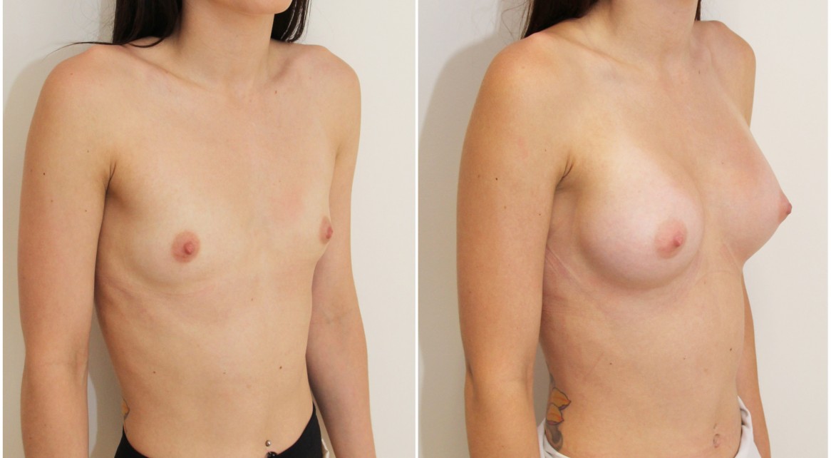 Early 20's, no children breast augmentation performed using 255g anatomical (teardrop) implants with dual plane 2 placement.