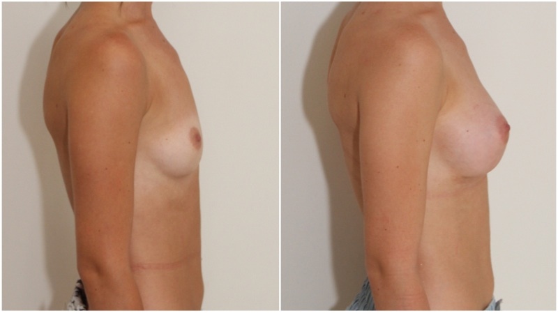 20s, asymmetrical, 255g anatomical right, 295g anatomical left, cohesive gel, submuscular augmentation.