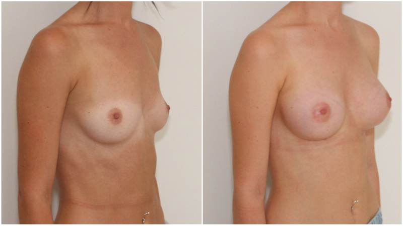 20s, asymmetrical, 255g anatomical right, 295g anatomical left, cohesive gel, submuscular augmentation.