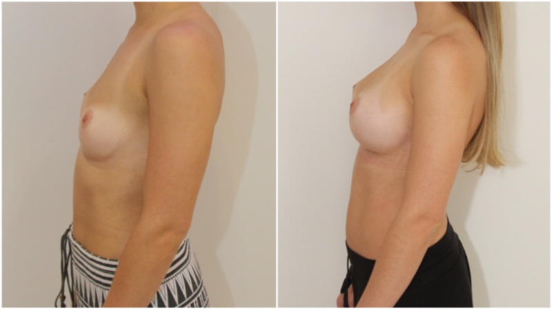 20s, 275g anatomical, submuscular placement.