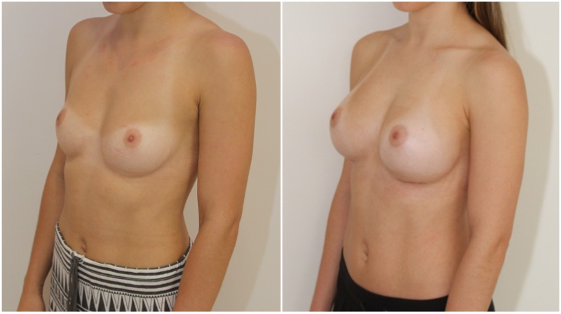 20s, 275g anatomical, submuscular placement.