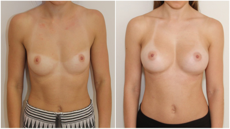 20s, 275g anatomical, submuscular placement.