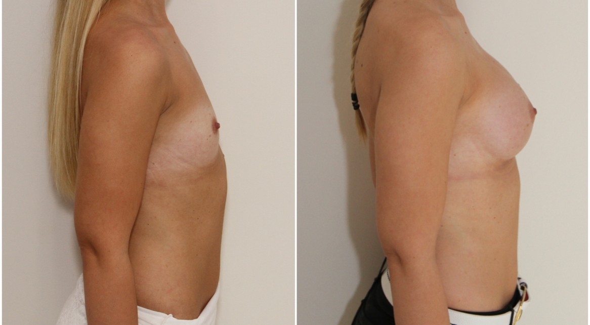 Dual plane 2 positioned, 295 g anatomical, memory gel style implants.