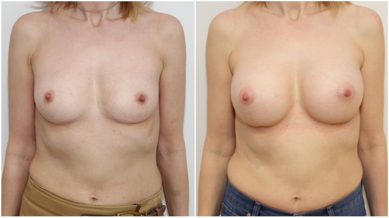 40s, 300cc round style, moderate plus profile, subfascial placement.