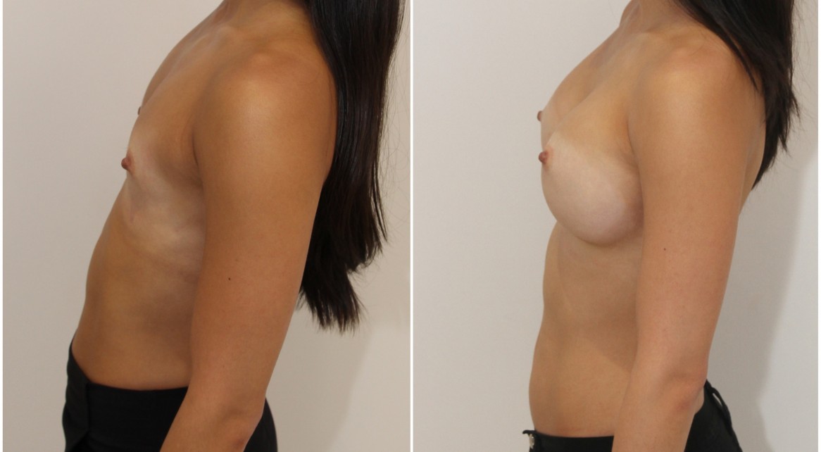 20s, dual plane 1, submuscular, 305g extra high profile, anatomical P-URE style, implants.
