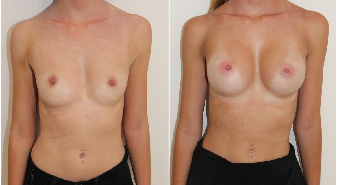 20s, enhanced style look achieved with 315g high profile, P-URE, anatomical implants, dual plane 2 placement.