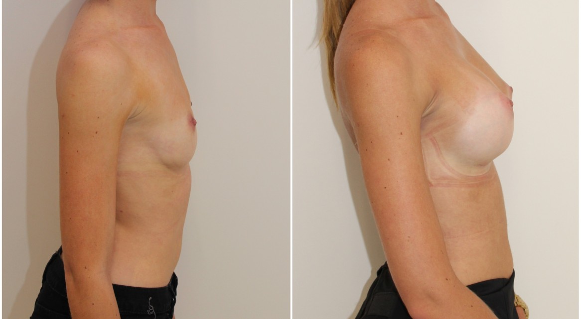 20s, enhanced style look achieved with 315g high profile, P-URE, anatomical implants, dual plane 2 placement.
