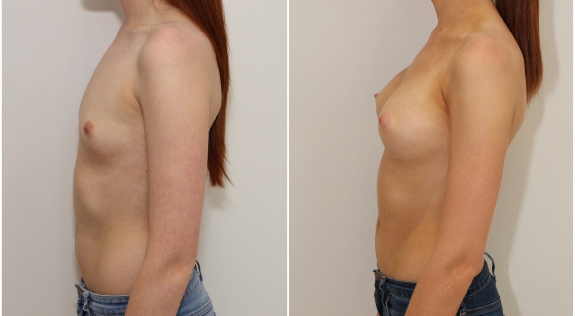 20s, 315g moderate profile, P-URE style, anatomical, dual plane 3 submuscular placement.