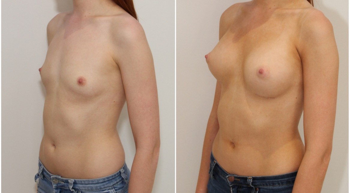 20s, 315g moderate profile, P-URE style, anatomical, dual plane 3 submuscular placement.