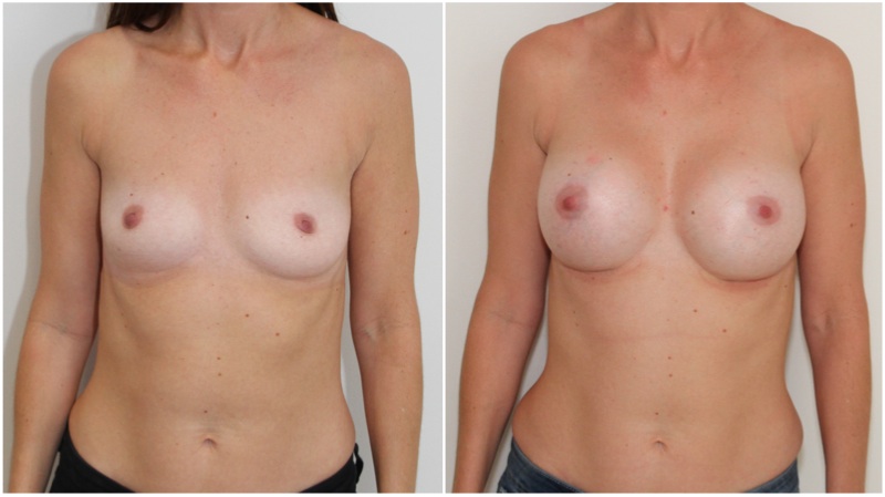330cc anatomical memory gel, dual plane 2 placement.