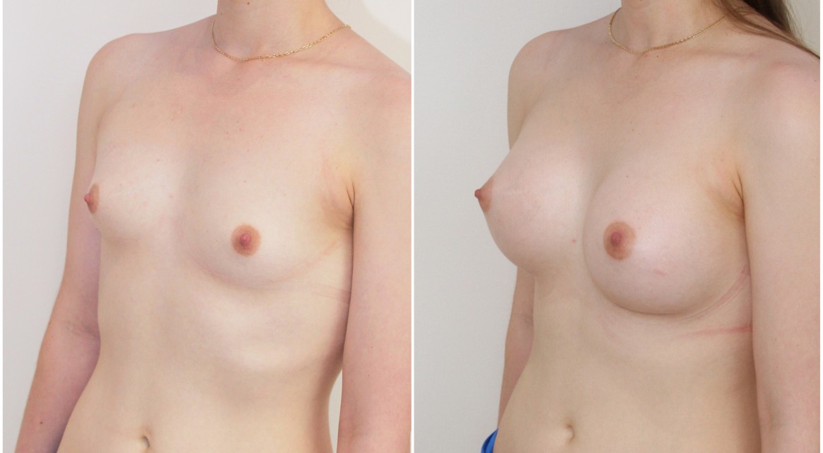 20s, no children, 330g moderate plus profile anatomical implants, dual plane positioned.