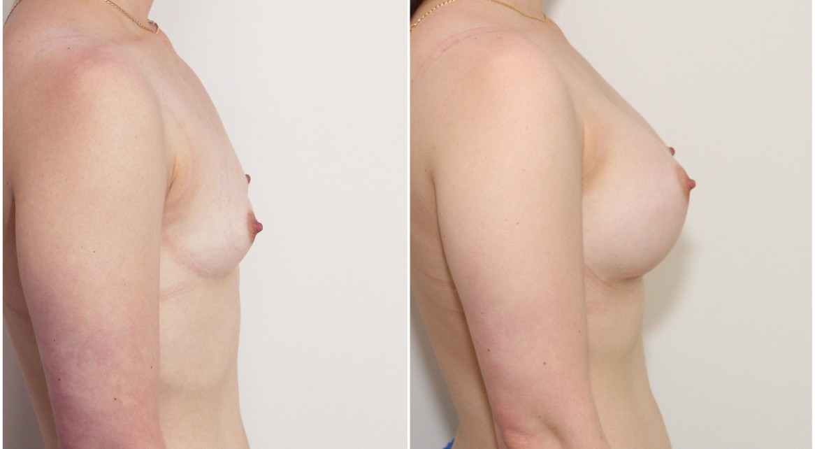 20s, no children, 330g moderate plus profile anatomical implants, dual plane positioned.
