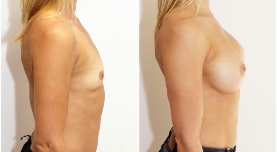 20s, 330cc mod plus profile anatomical implants, dual plane 2.