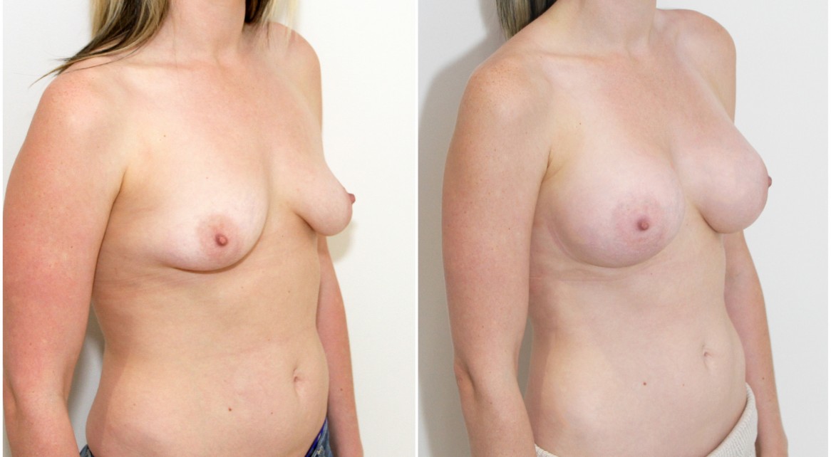 20s, 330cc subfascial anatomics to correct droop.
