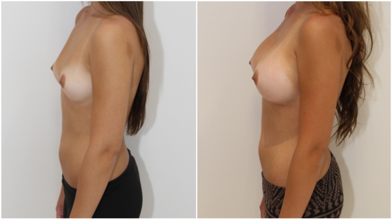 20s, asymmetry, augmentation with 350g round right, 400g left.