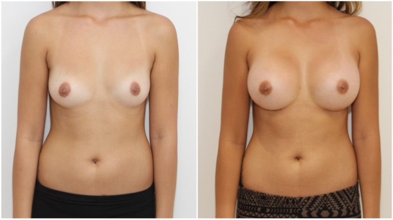 20s, asymmetry, augmentation with 350g round right, 400g left.