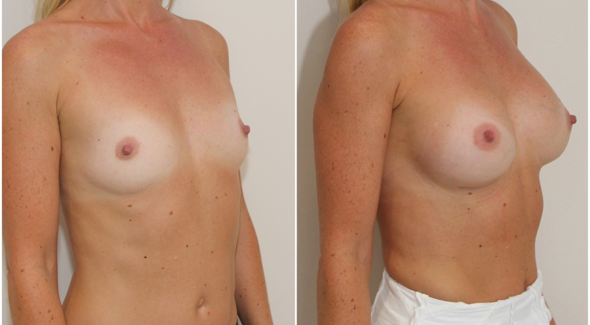 30s, 360g anatomical, moderate profile, submuscular placement.